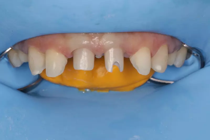 smile gallery | teeth gallery | artisan smile | VIP Dental Bangalore